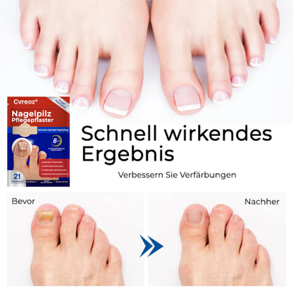 26 Packungen übrig! Cvreoz® Nagelpilz Pflegepflaster