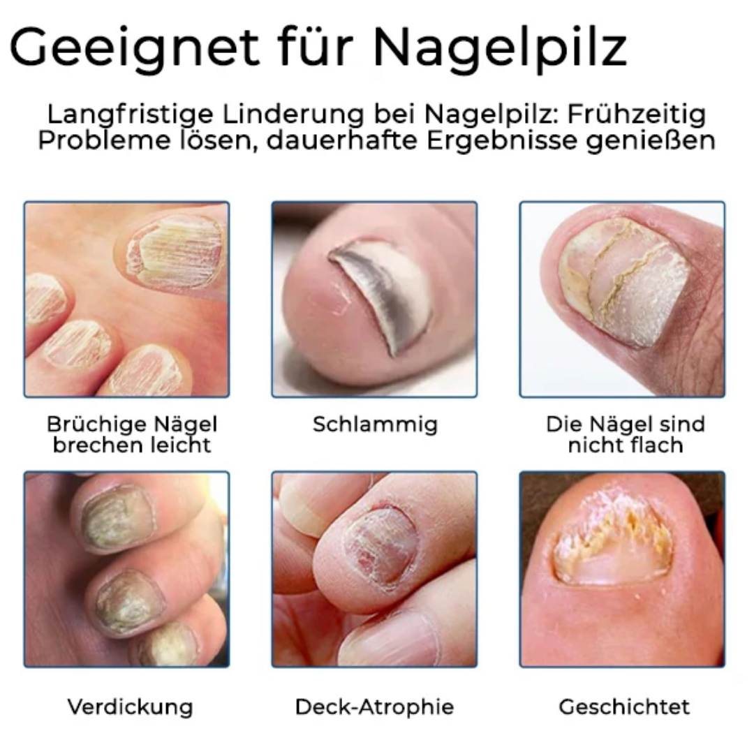 26 Packungen übrig! Cvreoz® Nagelpilz Pflegepflaster