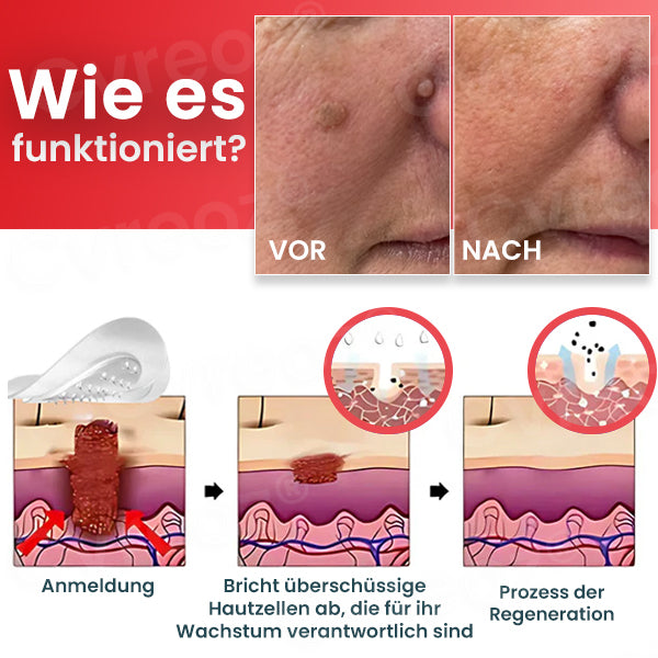 Cvreoz® Pro Microdarts Tags' weg Flicken -  BEFRISTETES ANGEBOT | Skin Tag No More!!! 💕