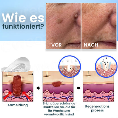 Cvreoz® Pro Microdarts Tags' weg Flicken -  BEFRISTETES ANGEBOT | Skin Tag No More!!! 💕
