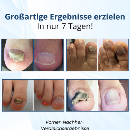 🏷️ EXKLUSIVES ANGEBOT! 50 % RABATT – AEXZR® MycoShield Pro Pilznagelpflaster