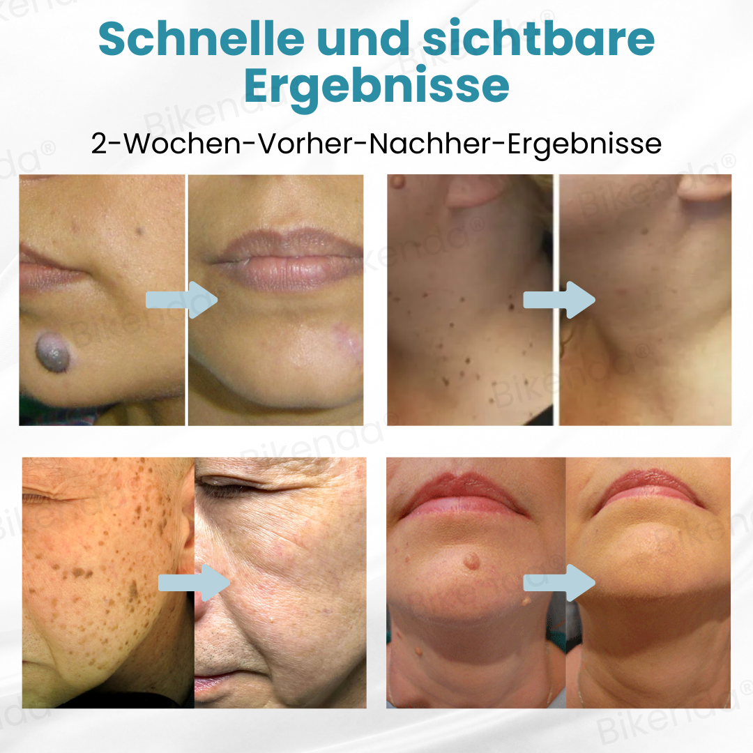 Bikenda® Nicht-invasiver Stift - und Warzenbehandlung Laserstift zum Entfernen