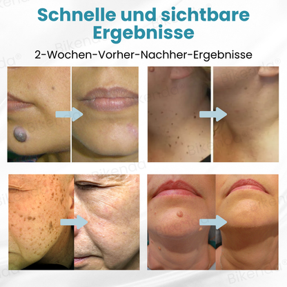 Bikenda® Nicht-invasiver Stift - und Warzenbehandlung Laserstift zum Entfernen