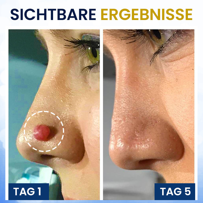 🏷️ EXKLUSIVES ANGEBOT! 50 % RABATT – AEXZR® Hautanhängsel-Kryo-Behandlungsspray